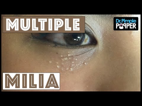 Multiple milia under the eyes